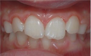 traumi dentali - prima